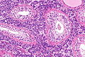 Testis with PCa - intermed. mag.
