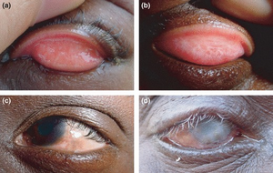 Trachoma 1.png