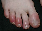 बिवाई अल्सर हैं जो पैर की अंगुलियों जैसे क्षेत्रों पर असर डालते हैं, ये तब हो सकते हैं जब एक संवेदनशील व्यक्ति ठण्ड या नमी के संपर्क में आता है।