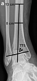 Tibiotalar surface angle (TTS) X-ray of frontal tibiotalar surface angle (TTS).jpg