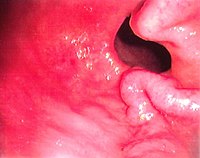 Antral varices, of Sarin classification IGV-2, an unusual class of gastric varices. Antral varices.jpg