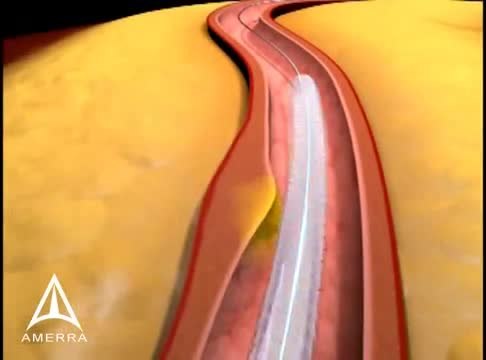 ملف:Arterial Stenting 3D Medical Animation.webm