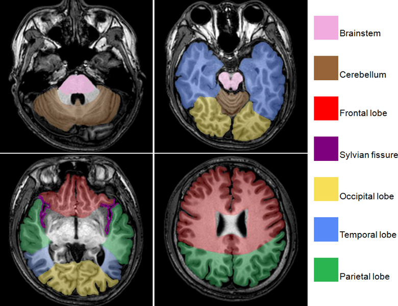 File:Brain regions on T1 MRI.png