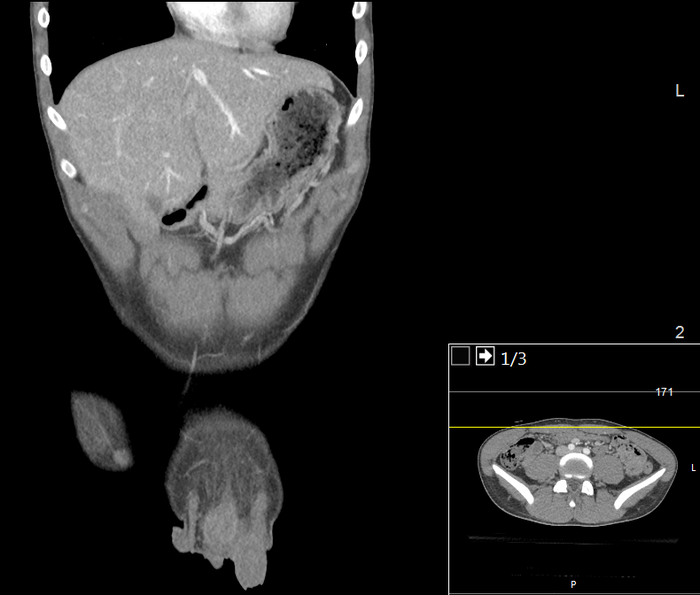 CT of a normal abdomen and pelvis, coronal plane 35.png