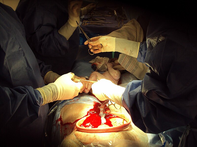 File:Caesarian section, 2011.jpg