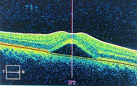 Central serous retinopathy.jpg