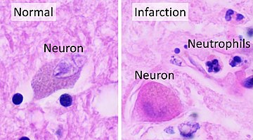 Histopathology at high magnification of a normal neuron, and an ischemic stroke at approximately 24 hours on H&E stain: The neurons become hypereosinophilic and there is an infiltrate of neutrophils. There is slight edema and loss of normal architecture in the surrounding neuropil. Histopathology of thalamus infarction at approximately 24 hours, high magnification, annotated.jpg