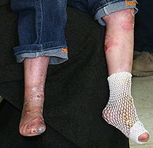 Iraqi-boy-epidermolysis bullosa-090216-M-8096M-00-legs.jpg