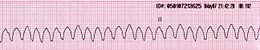 Taquicardia ventricular de ritmo de derivação II Vtach VT.JPG