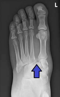 Lisfranc injury is one cause of foot arch pain that's not plantar fasciitis