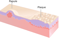 Chigger bites on human skin showing characteristic welts