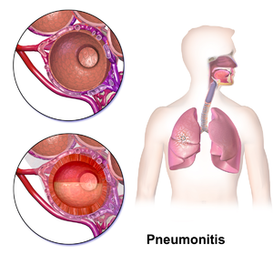 Pneumonitis.png