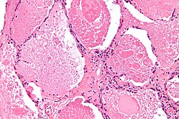 Resim açıklaması Pulmoner alveolar proteinosis -3- high mag.jpg.