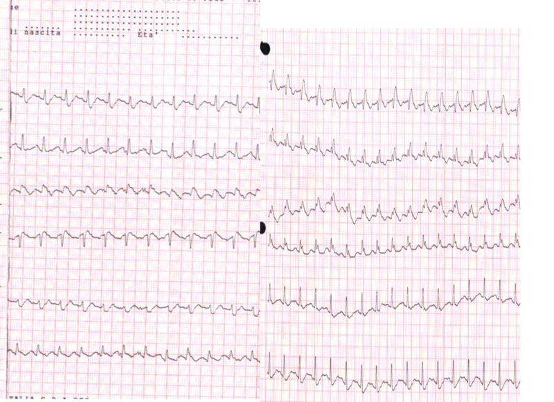 File:Pulmonary embolism ECG.jpg