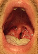 Infeção de garganta com cultivo positivo de estreptococos do grupo A. Repare-se nas amigdalas inflamadas com exsudatos esbranquiçada.[19]