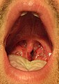 A case of strep throat. Note the large tonsils with white pus.