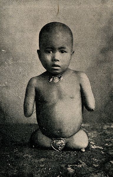 File:A child with stumps for its limbs, being exhibited. Reproduc Wellcome V0007410EL.jpg