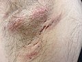 Miniatura para Hidradenitis supurativa