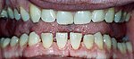 Povečanje prostorov med spodnjimi zobmi zaradi prekomerno povečane spodnje čeljustnice pri bolniku z akromegalijo