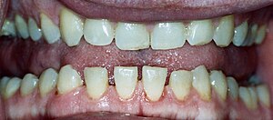 Acromegalyteethgapping.jpg