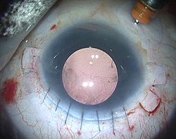 Fig 7B : Cataract removed, anti glaucoma surgery done and an aniridic glued IOL fixed which has artificial iris and IOL. Aniridia glued IOL B.jpg