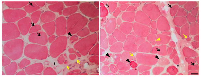 Photomicrograph of muscle affected by calpainopathy. Seen in these views are endomysial fibrosis (black asterisks), central nuclei (black arrows), fiber splitting (yellow triangle), necrosis (black triangles), atrophic fibers (yellow arrows), and increased variation in size and shape.