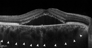 Central serous chorioretinopathy with increased choroidal thickness.png