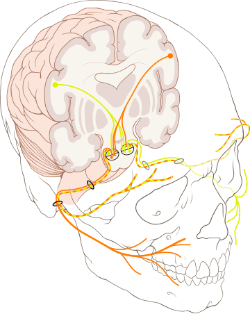 Paràlisi facial