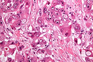 <span class="mw-page-title-main">Fibrolamellar hepatocellular carcinoma</span> Medical condition