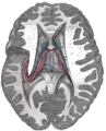 Tela corioidea del terzo ventricolo, e plesso corioideo del ventricolo laterale sinistro, vista dall'alto.