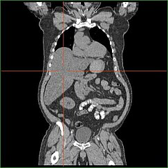 Hepatomegaly via CT scan.