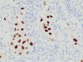 Immunohistochemistry stain for SOX10 in a metastatic melanoma to a lymph node.jpg