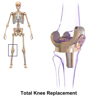 <span class="mw-page-title-main">Knee replacement</span> Surgical procedure