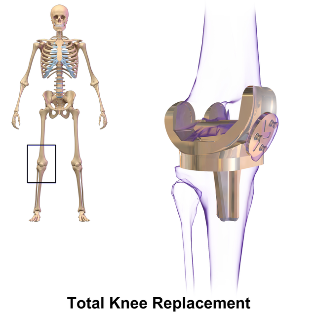 Knee replacement - Wikipedia