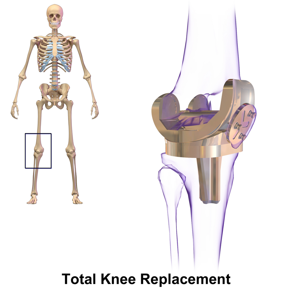 Knee Replacement-avatar