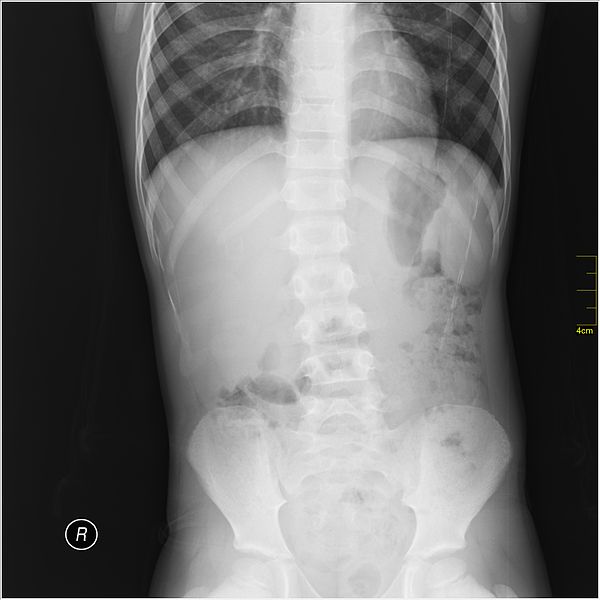 File:Medical X-Ray imaging UIE07 nevit.jpg