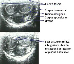 Peyronie's Disease Ultrasound.jpg