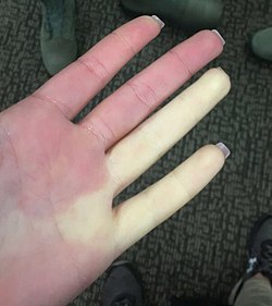 Raynaud syndrome on female airman's hand.jpg