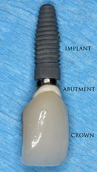 Titanový zubní implantát s nasazenou korunkou, který se používá k náhradě jednoho zubu.