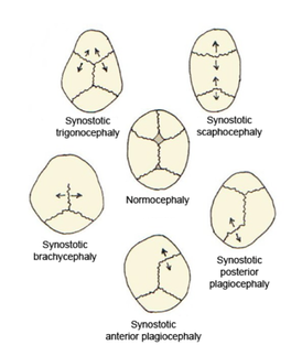 Деформации черепа: внизу справа — синостозная затылочная плагиоцефалия, внизу в центре — синостозная лобная плагиоцефалия