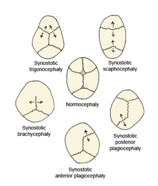 Single suture synostosis.png