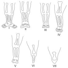 Classification of sirenomelia by the presence or absence of bones within the lower limb.
I) all bones of thigh and lower leg present
II) fused fibula
III) fibula absent
IV) partially fused femur, fused fibula
V) partially fused femur
VI) fused femur, fused tibia
VII) fused femur, tibia absent Sirenomelia.svg