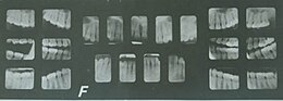 X-Ray of an unidentified murder victim's teeth found in 1976 Sumter Jane Doe Teeth.jpg