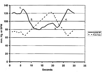 Blood pressure (systolic) and pulse rate during a normal response to a Valsalva maneuver. Forty-millimeter mercury pressure is applied at 5 seconds and relieved at 20 seconds. Valsalva3.jpg