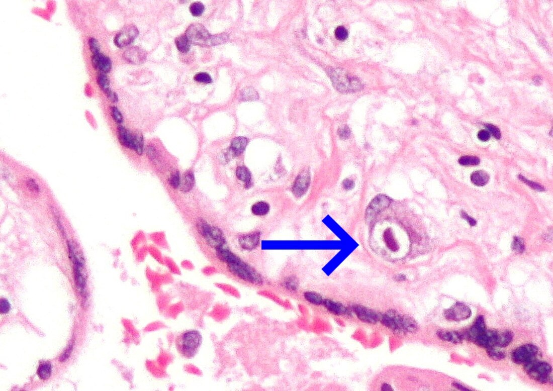 Infecció per transmissió vertical