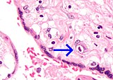 Micrograph of a cytomegalovirus (CMV) infection of the placenta (CMV placentitis). The characteristic large nucleus of a CMV-infected cell is seen off-centre at the bottom-right of the image. H&E stain. CMV placentitis1 mini.jpg