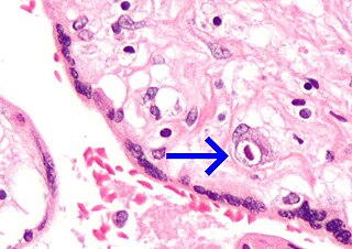 Micrograph of a cytomegalovirus (CMV) infection of the placenta (CMV placentitis). The characteristic large nucleus of a CMV-infected cell is seen off-centre at the bottom-right of the image. H&E stain.