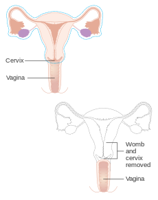 Diagram showing parts of the body removed with a radical hysterectomy CRUK 180.svg