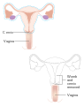 Diagram showing parts of the body removed with a radical hysterectomy CRUK 180.svg