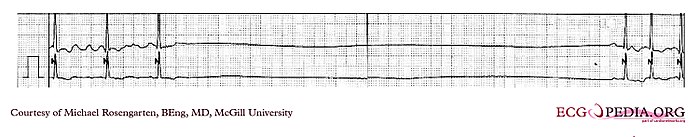 E000744 (CardioNetworks ECGpedia).jpg